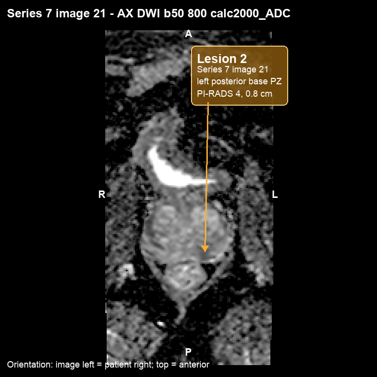 MRI ADC image, Series 7 image 21, with a callout marking Lesion 2 in the left posterior peripheral zone