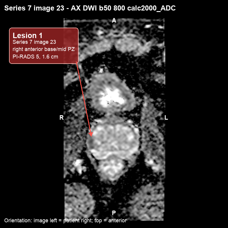 MRI ADC image, Series 7 image 23, with a callout marking Lesion 1 in the right anterior peripheral zone