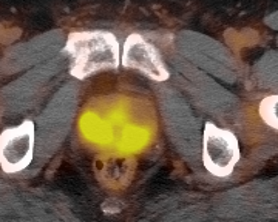 PSMA PET/CT fusion slice showing bright tracer uptake centered in the prostate