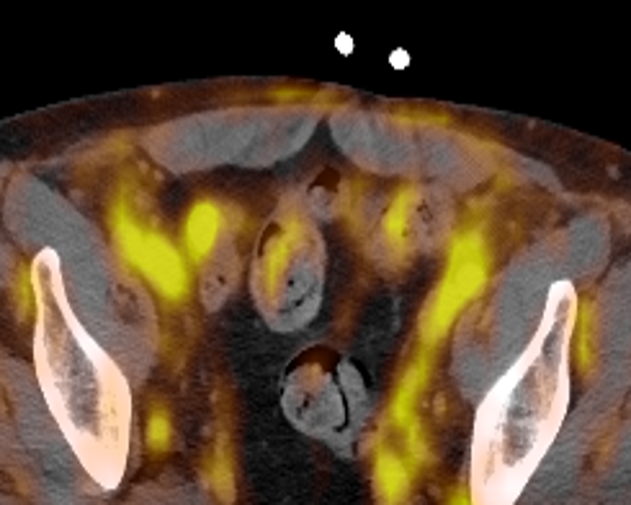 PSMA PET/CT fusion slice at the obturator-node level of the pelvis